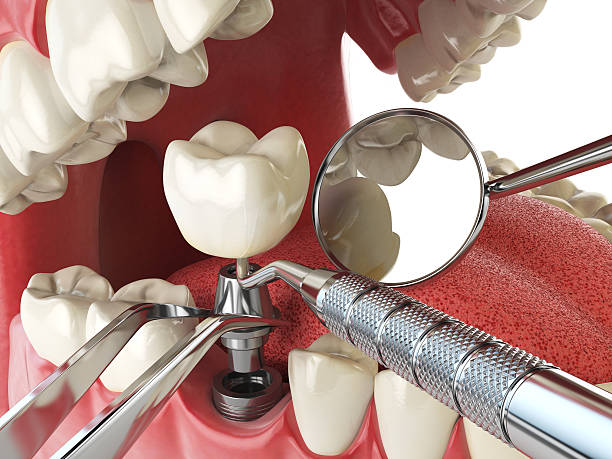 Best Emergency Dental Care for Broken or Chipped Teeth in Ocala, FL